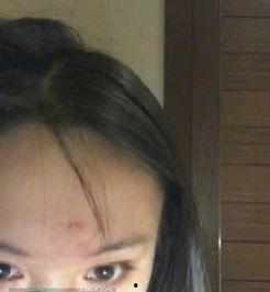 吃瓜会长痘嘛,揭秘瓜果摄入与皮肤健康的关系