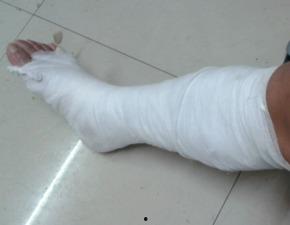 骨折术后恢复吃蜜瓜,蜜瓜助力营养补给与康复加速